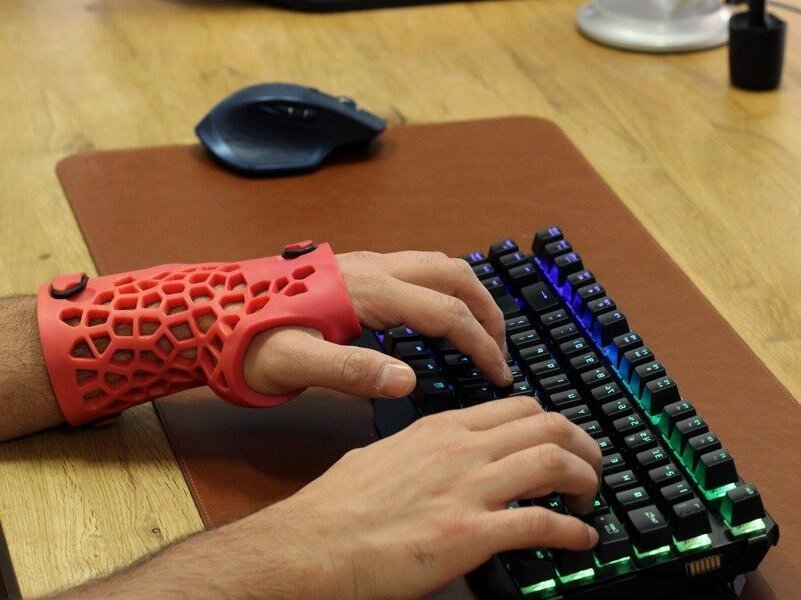 A person wearing a 3D printed cast from CAST3D while typing on a keyboard.